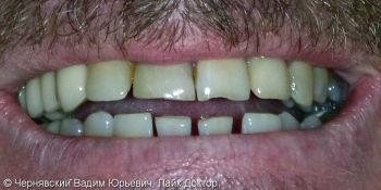 Реставрация зубов люминирами фото до лечения